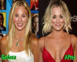 Kaley Cuoco before surgery